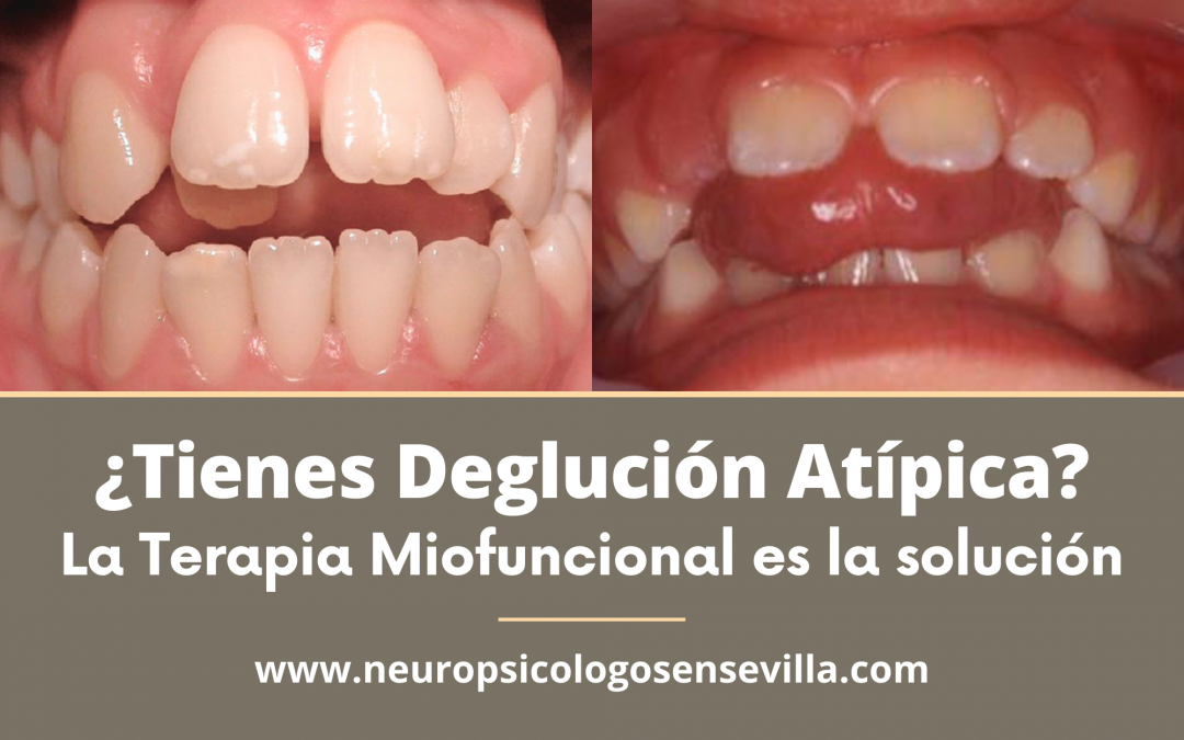 ¿Tienes Deglución Atípica? La Terapia Miofuncional es la solución